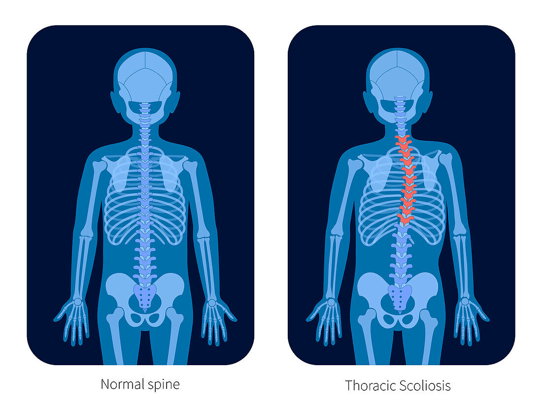 Healthy spine and scoliosis, illustration