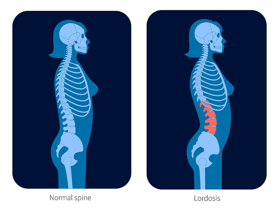 Healthy spine and scoliosis, illustration