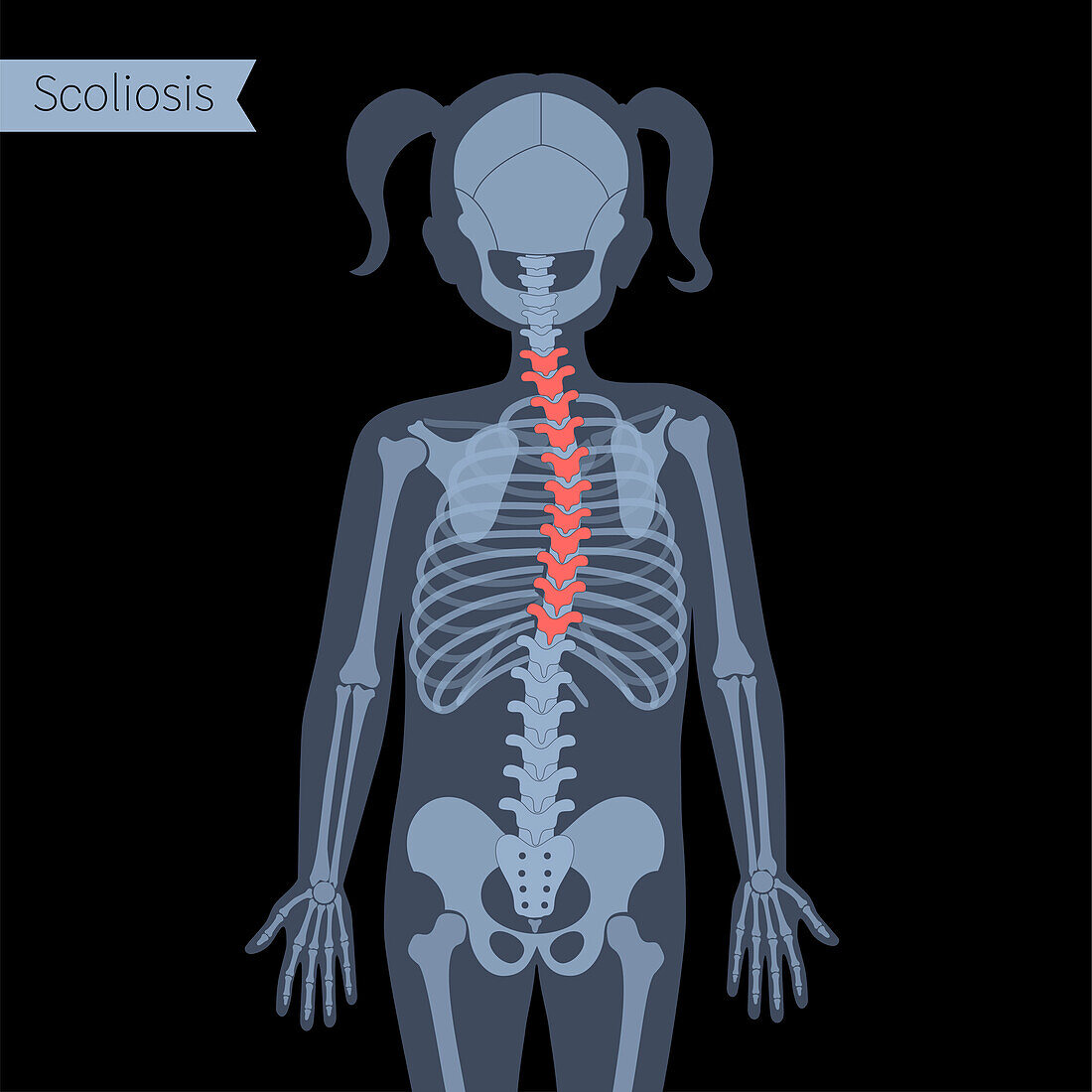 Scoliosis, illustration