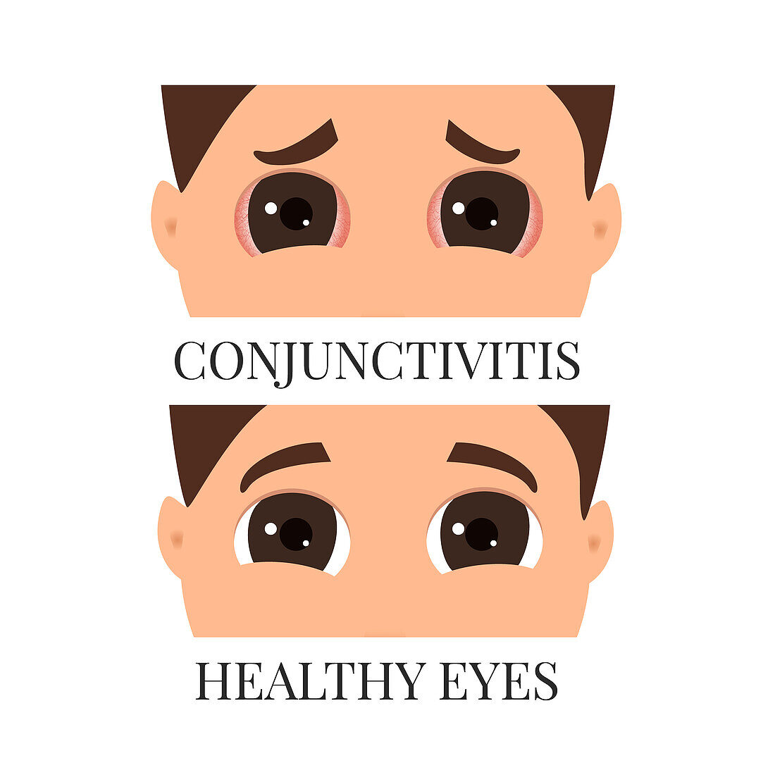 Conjunctivitis, conceptual illustration