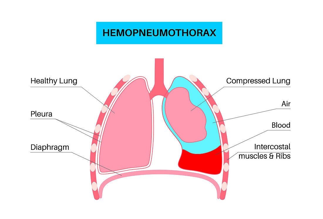 Haemopneumothorax, illustration