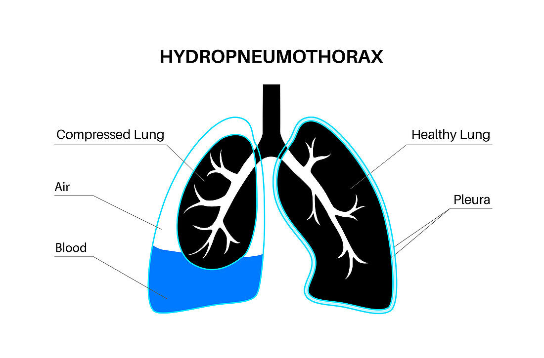 Hydropneumothorax, illustration