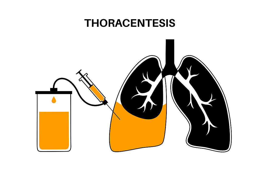 Thoracentesis medical procedure, illustration