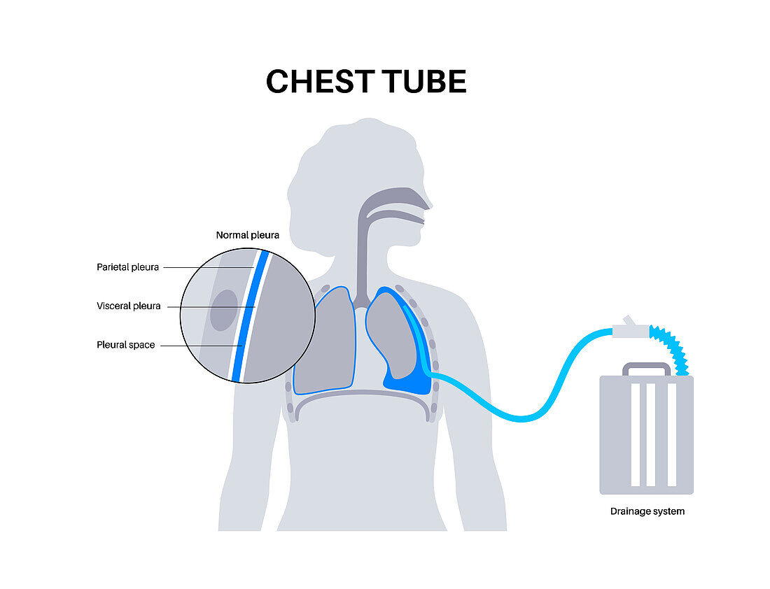 Chest tube catheter, illustration