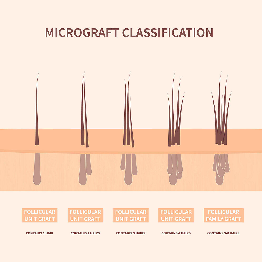Hair graft types, conceptual illustration
