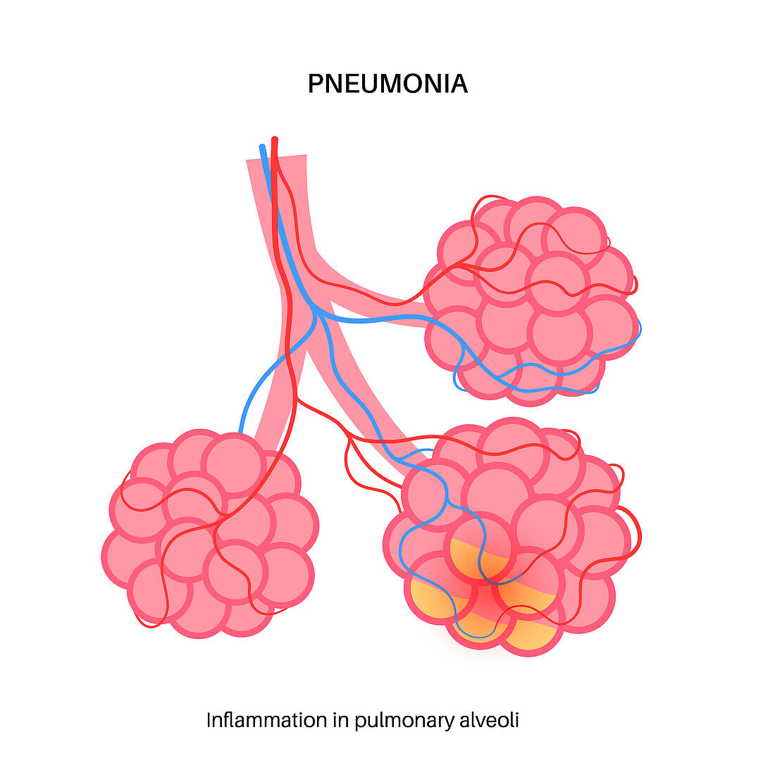 Pneumonia infection, conceptual illustration