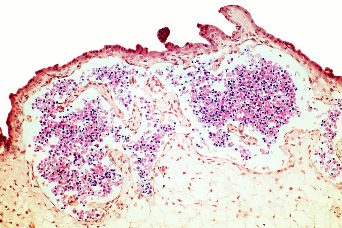 Nucleated RBCs in placental, LM