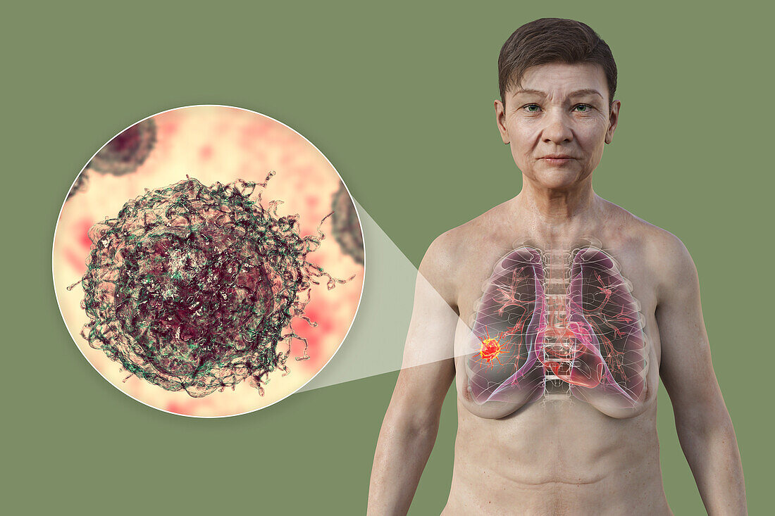 Woman with lung cancer, illustration