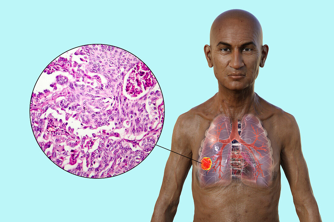 Man with lung cancer, illustration