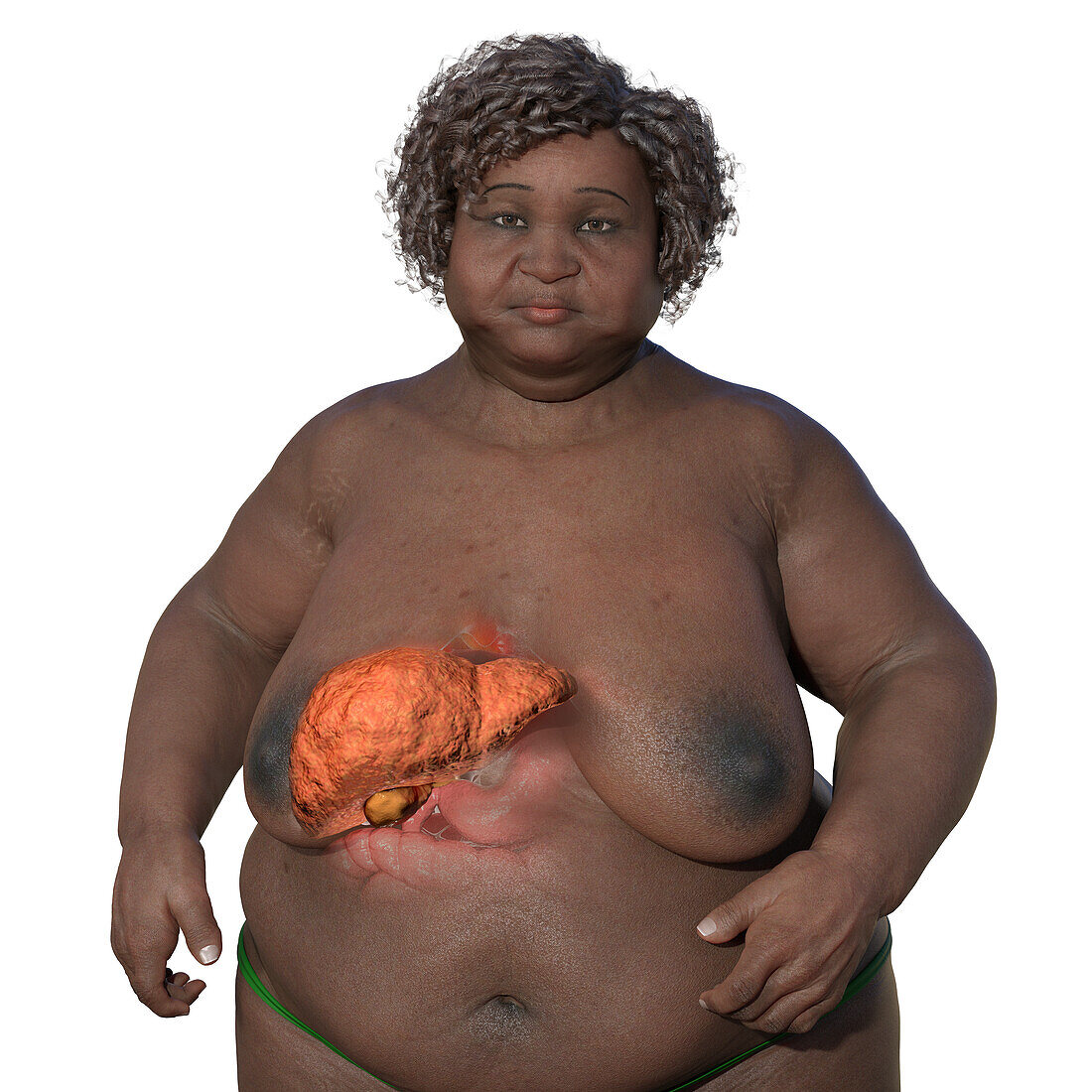 Overweight woman with liver steatosis, illustration
