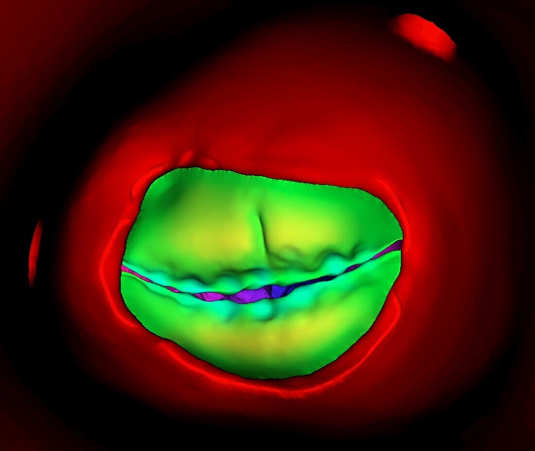 Bicuspid aortic valve, 3D CT-based illustration