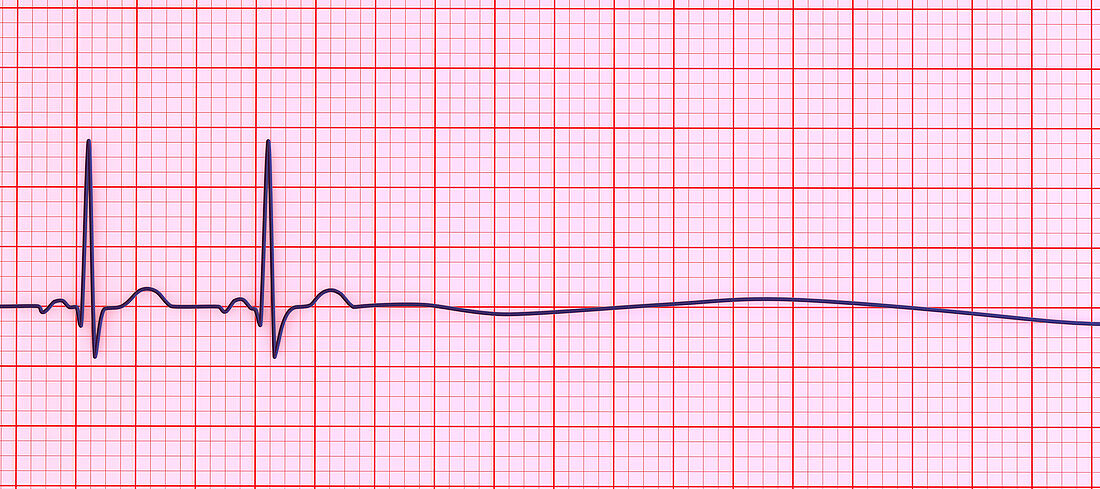 Asystole cardiac arrest, illustration