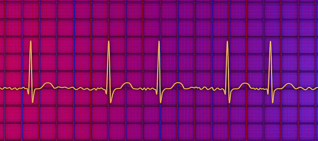 Atrial fibrillation irregular heartbeat rhythm, illustration