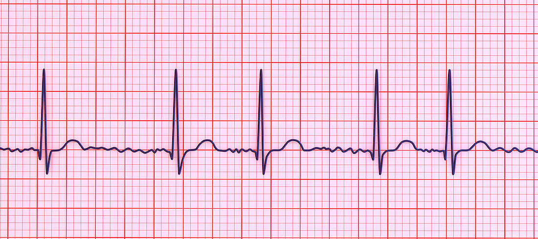 Atrial fibrillation irregular heartbeat rhythm, illustration