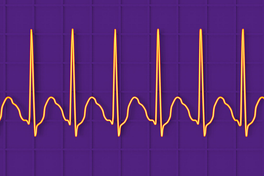 Atrial flutter abnormal heartbeat rhythm, illustration