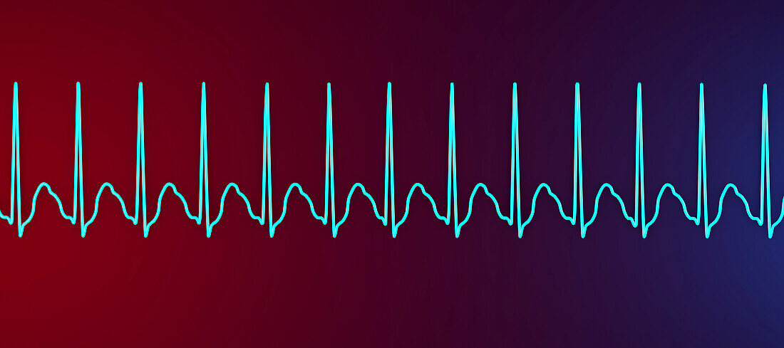 Supraventricular tachycardia heartbeat rhythm, illustration