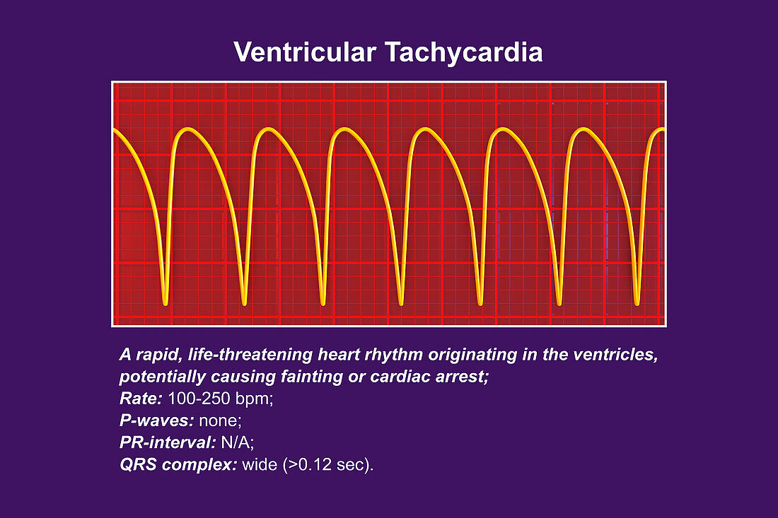 Ventricular tachycardia heartbeat rhythm, illustration