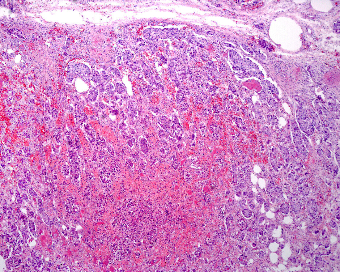 Adrenal cortex carcinoma, light micrograph
