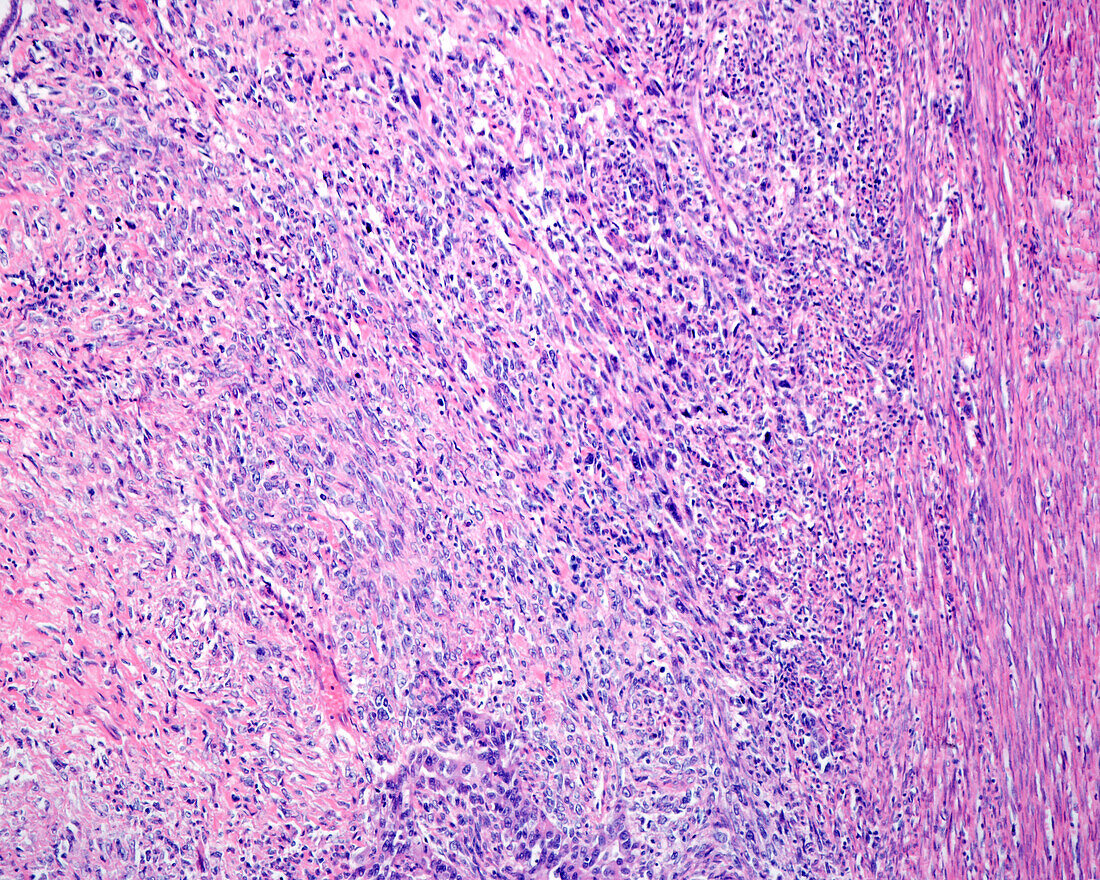 Uterine sarcoma, light micrograph