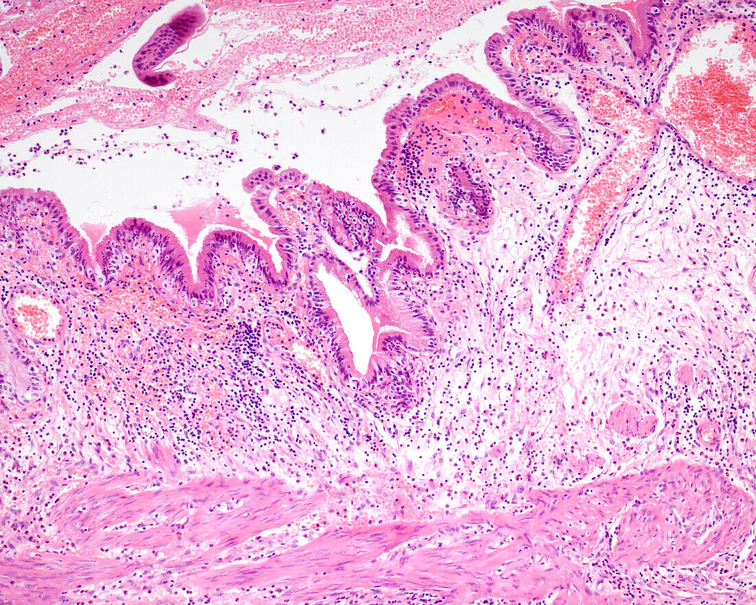 Gangrenous cholecystitis, light micrograph