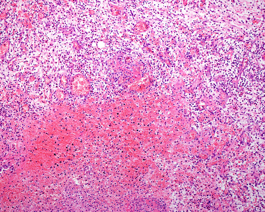 Chronic inflamed tissue, light micrograph