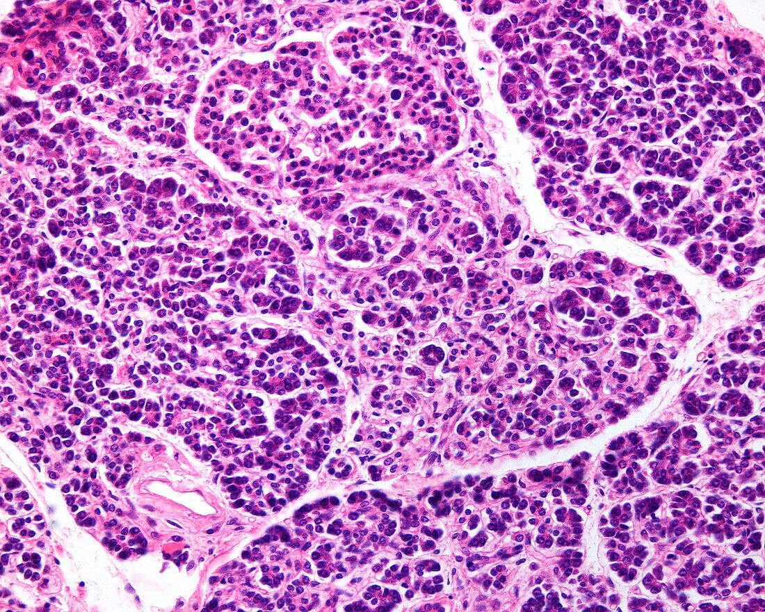 Pancreas in type 2 diabetes mellitus, light micrograph