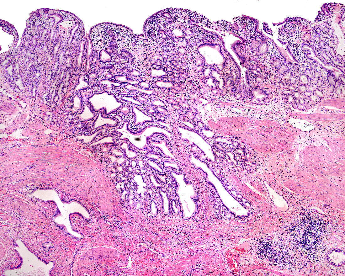 Gallbladder adenocarcinoma, light micrograph