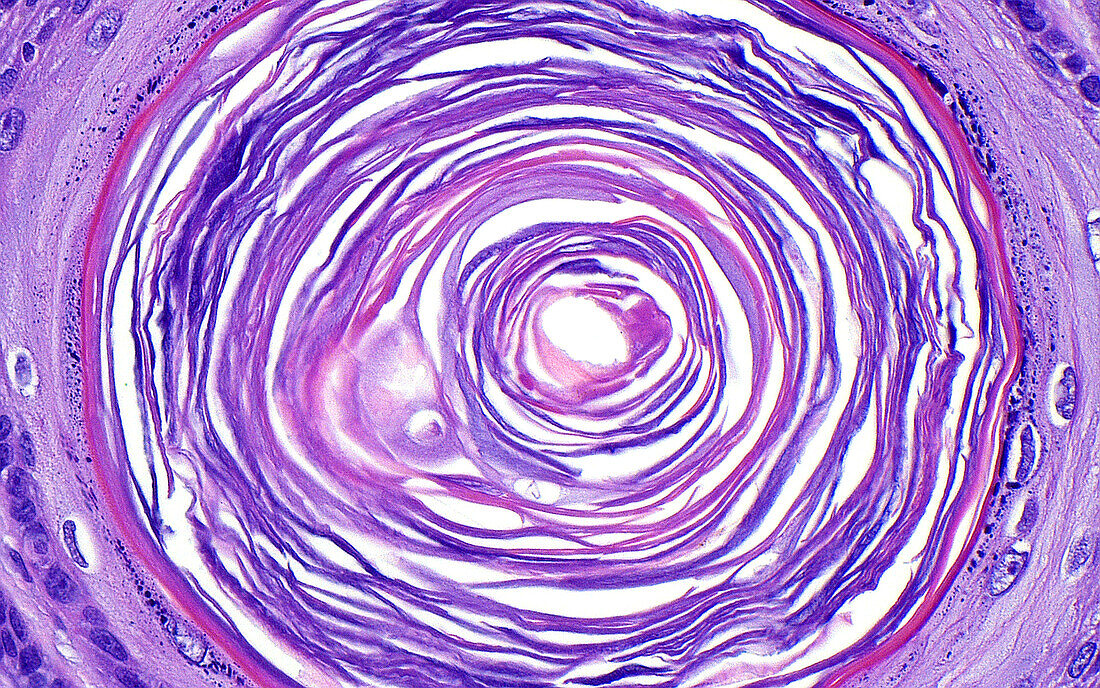 Keratin horn cyst (seborrheic keratosis), light micrograph