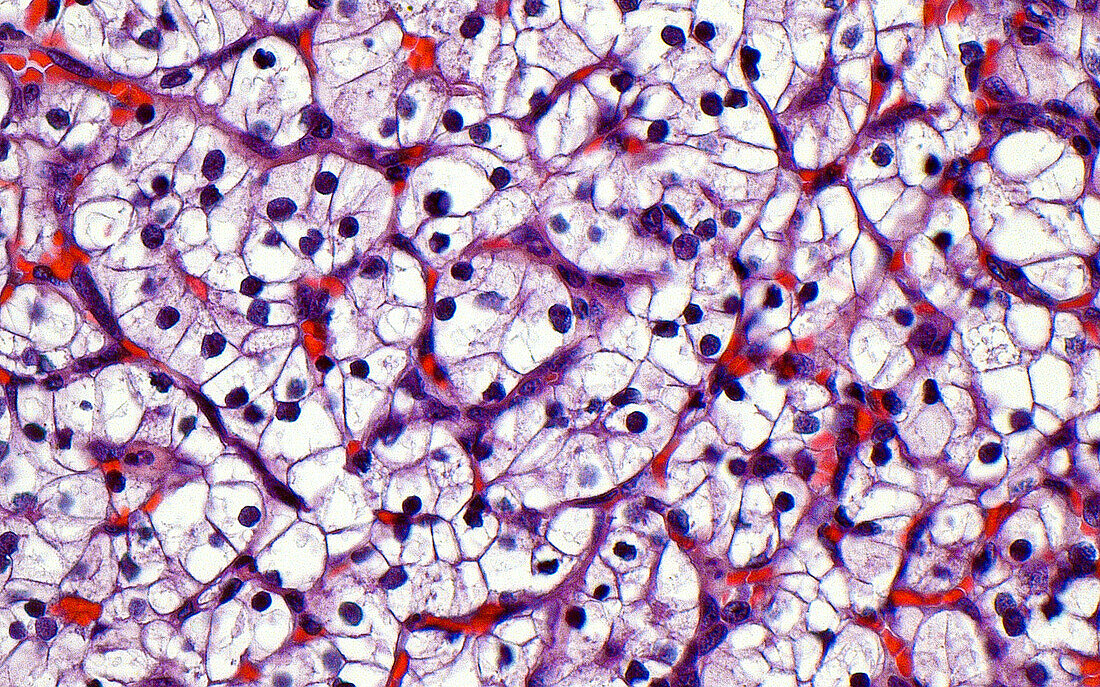 Clear cell kidney cancer, light micrograph
