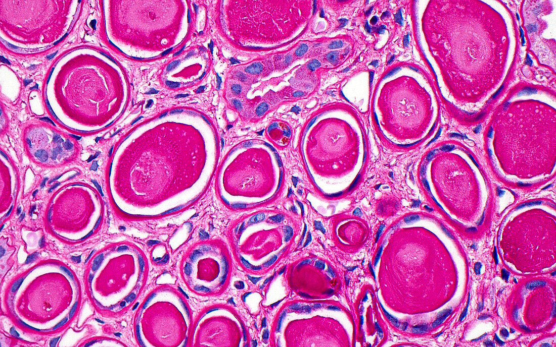 Atrophic renal tubules, light micrograph