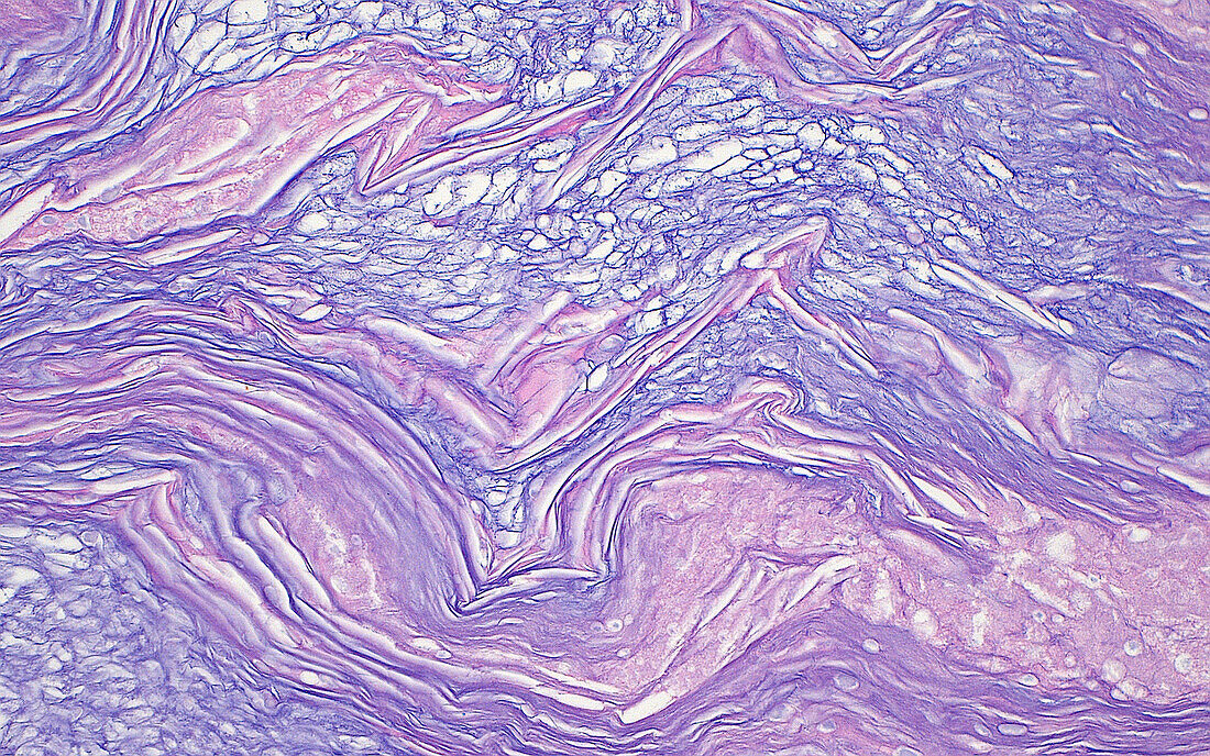 Mucin from ovarian cyst, light micrograph
