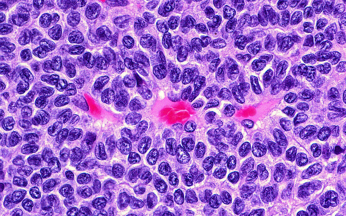 Adult granulosa cell tumour, light micrograph