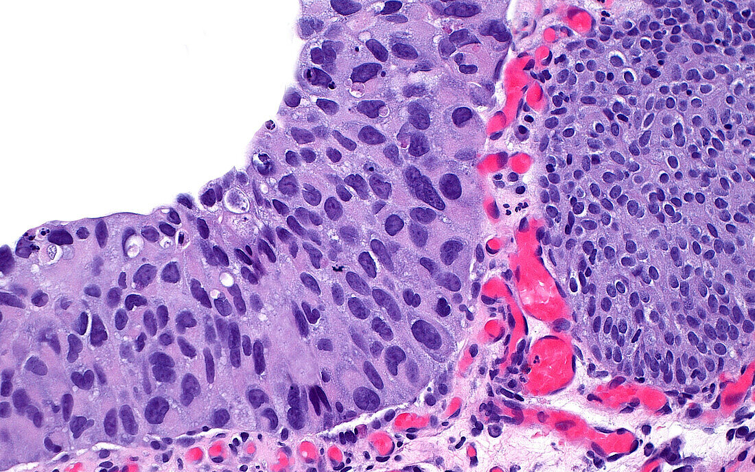 Urothelial carcinoma in situ, light micrograph
