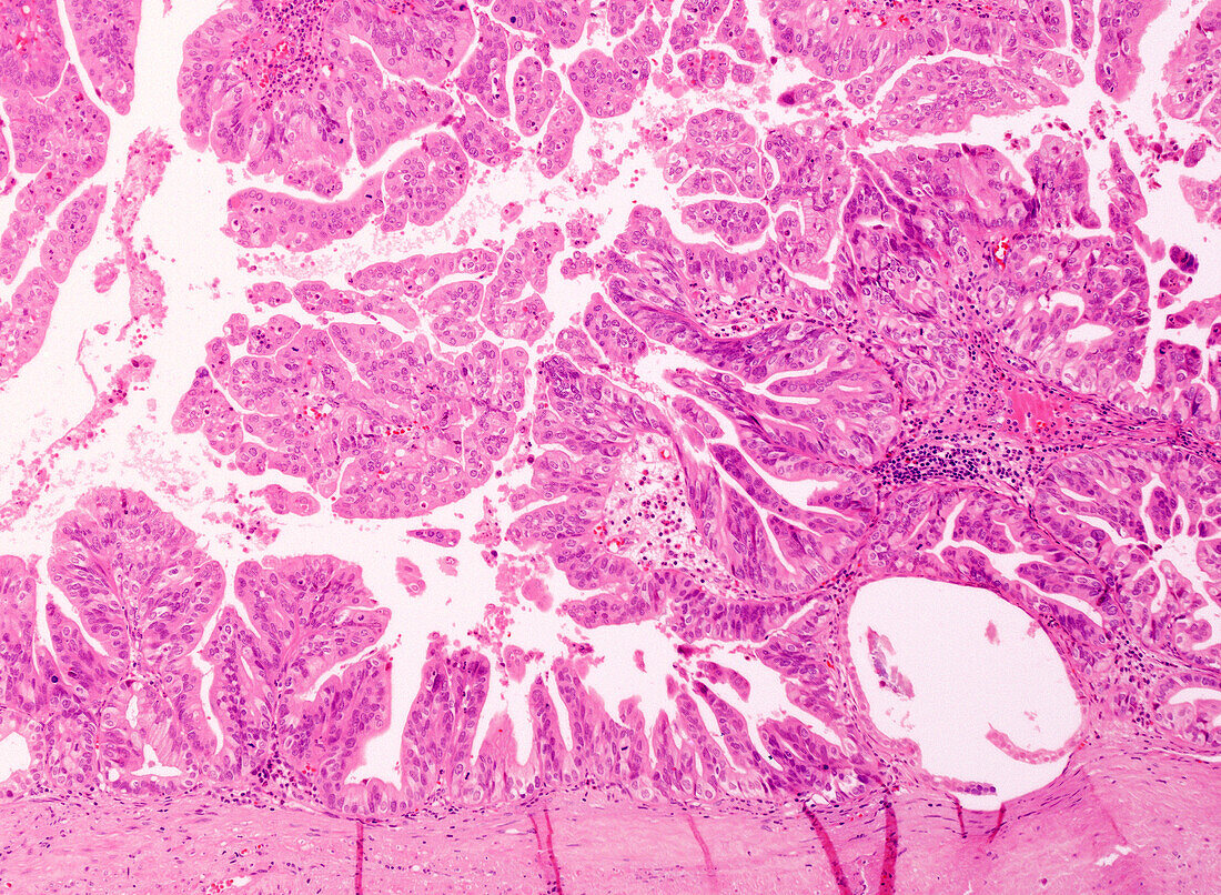 Intracholecystic papillary neoplasm, light micrograph
