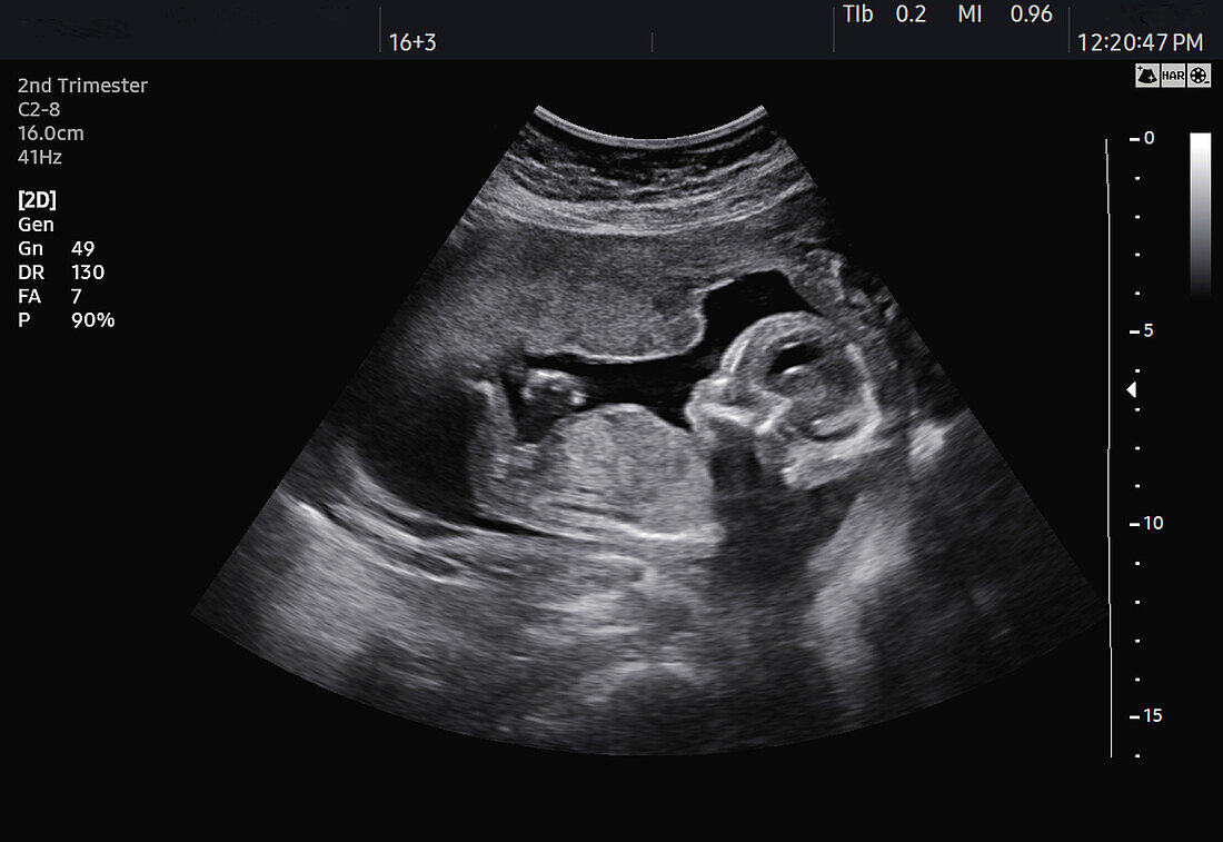 Second trimester foetus, ultrasound scan