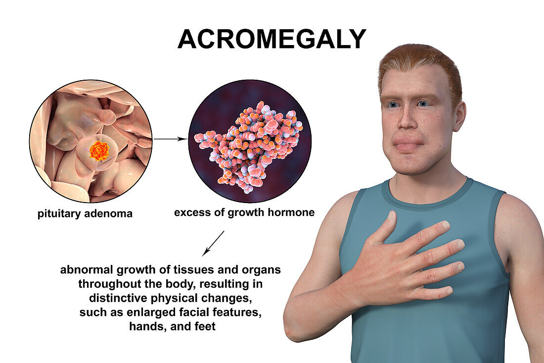 Acromegaly, illustration