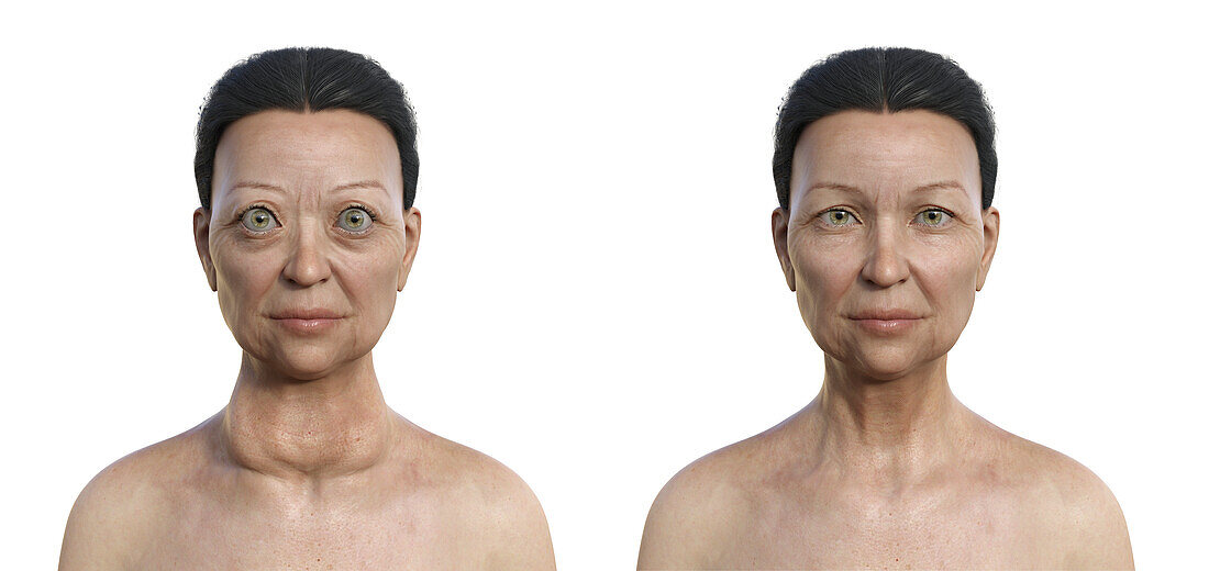 Woman with Graves' disease, illustration