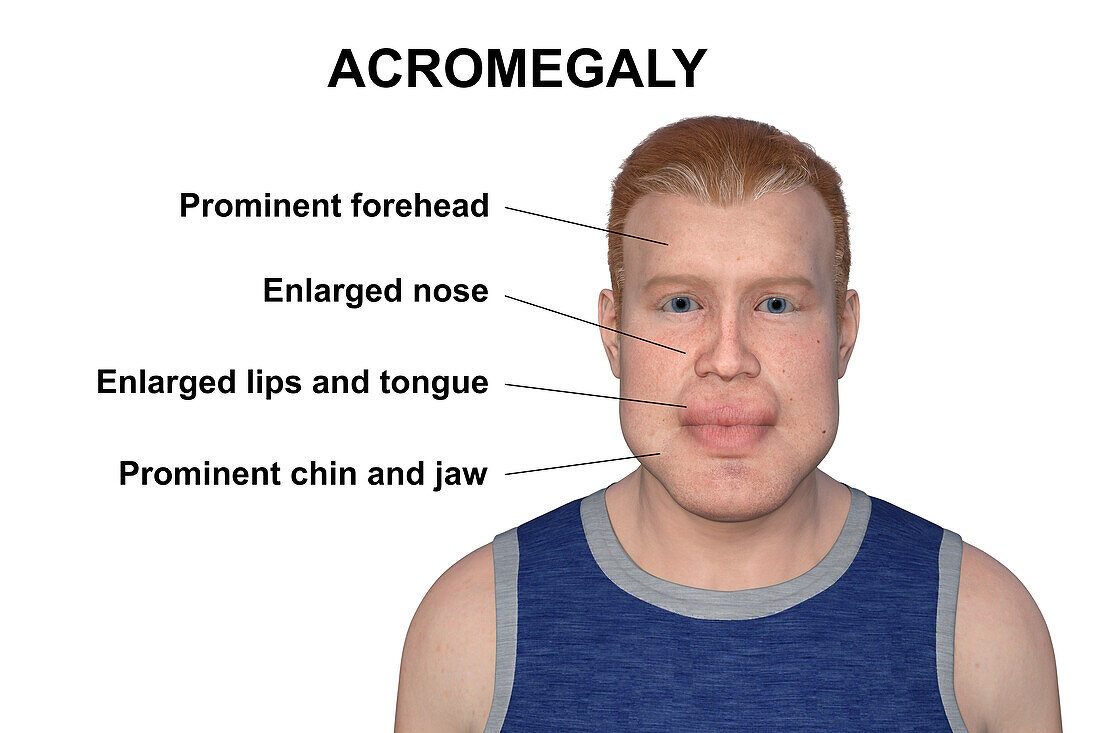 Acromegaly in a man, illustration