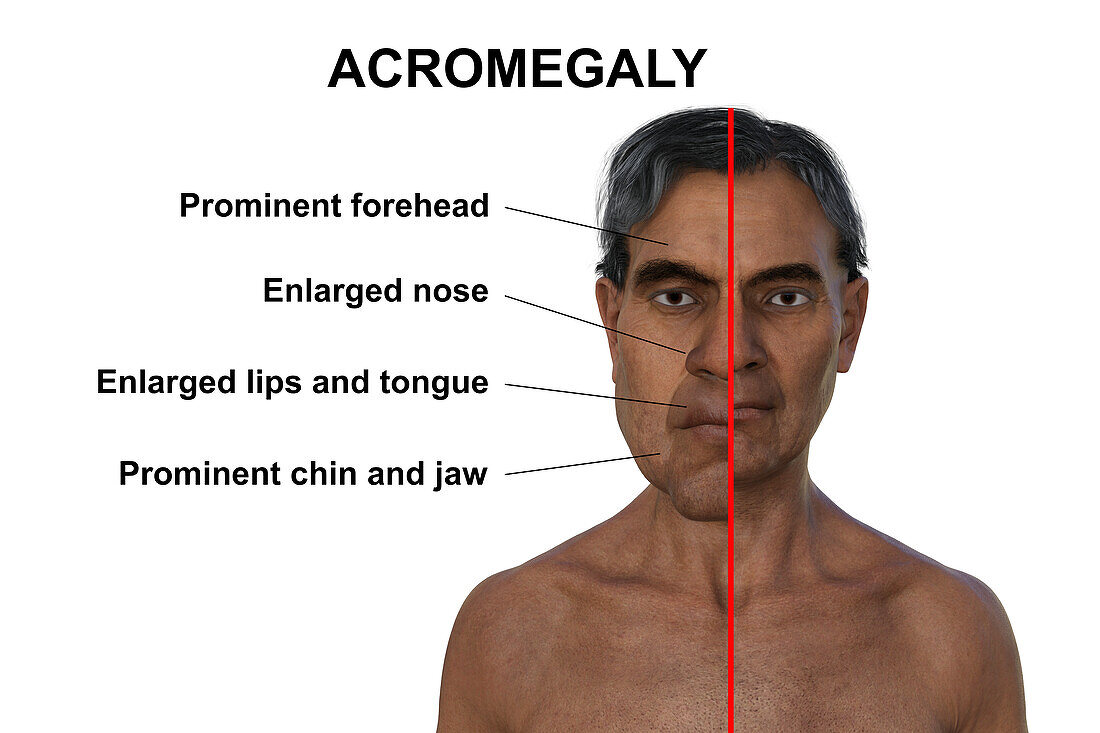 Acromegaly in a man compared to healthy man, illustration