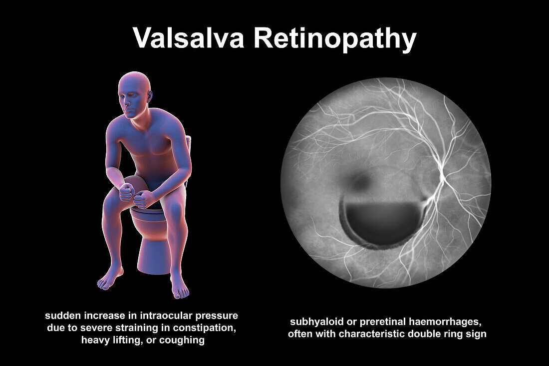 Valsava retinopathy, illustration