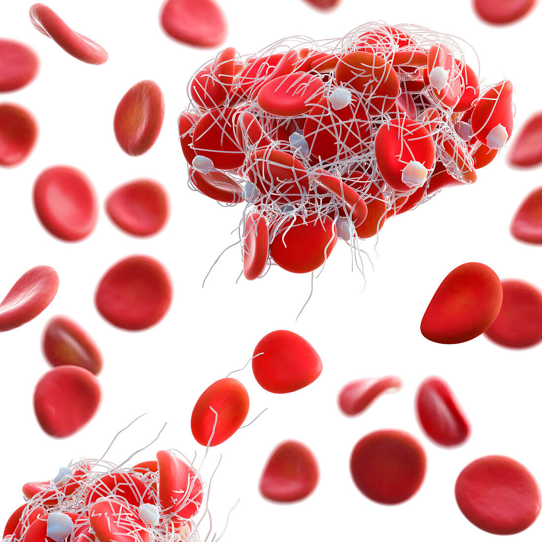 Blood clot, illustration