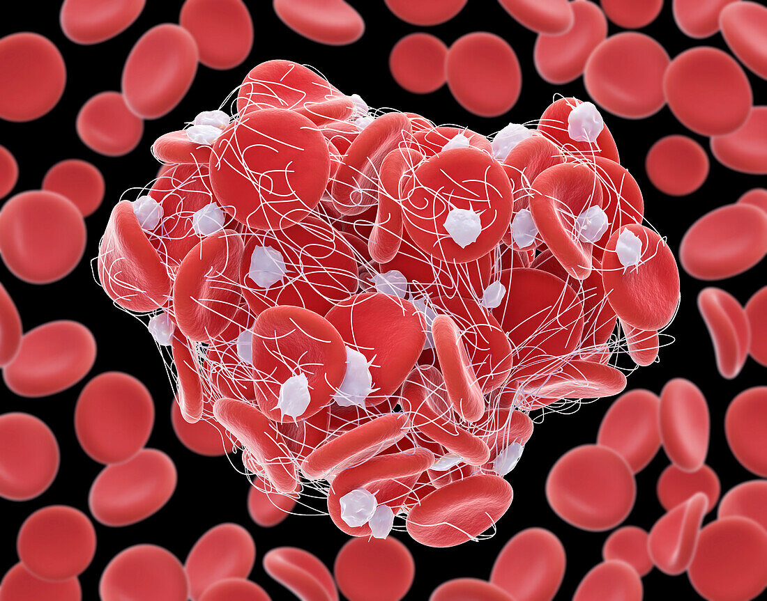 Blood clot, illustration