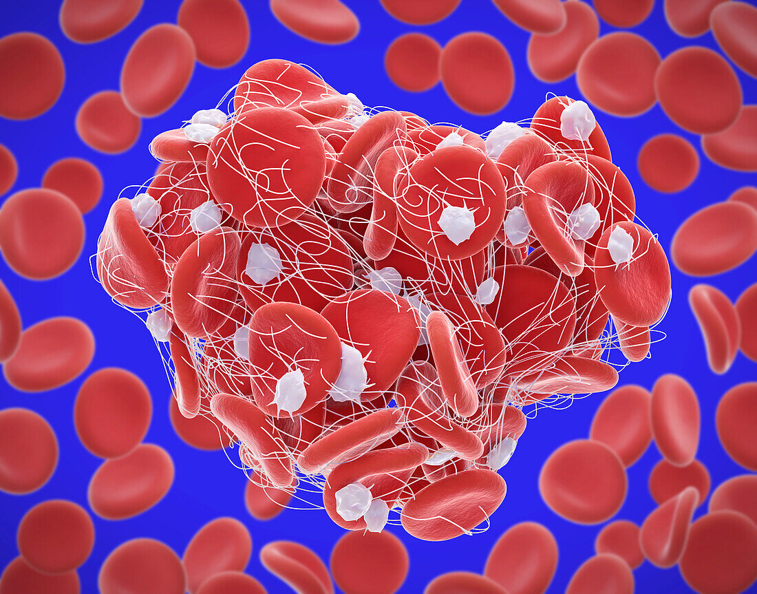 Blood clot, illustration