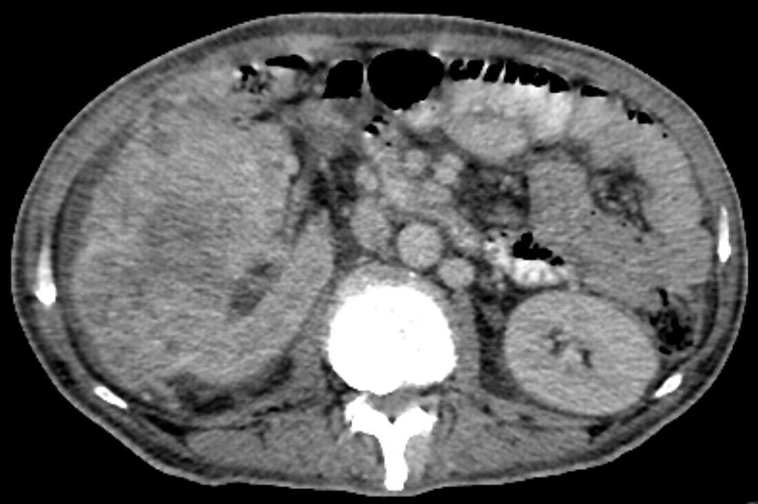 Renal carcinoma, CT scan