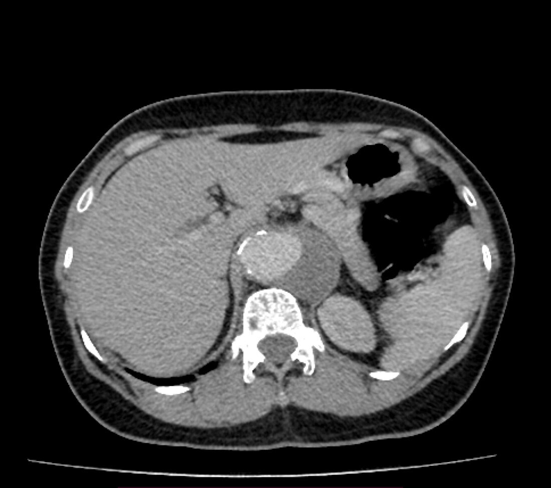 Abdominal aortic aneurysm, CT scan