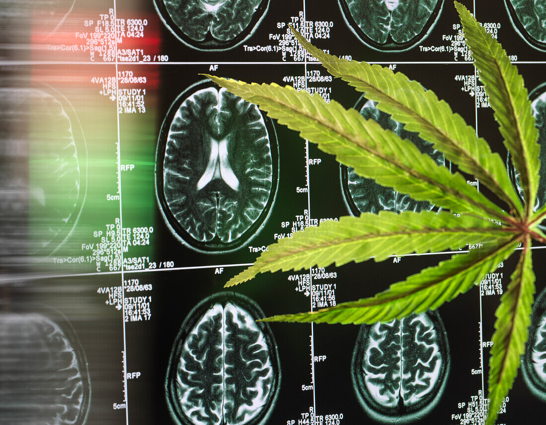Cannabisblatt am Gehirnscan als Heilmittel für Demenz und Alzheimer