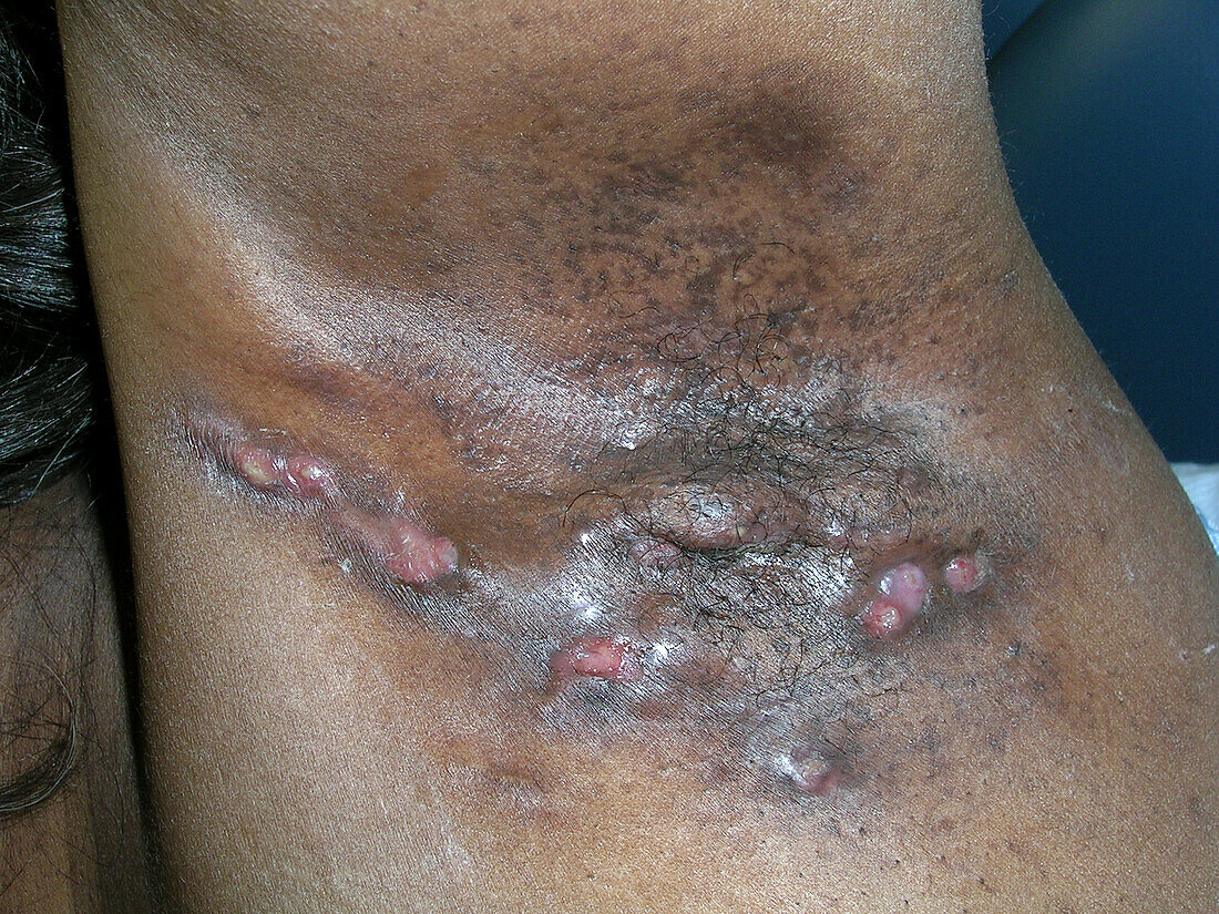 Hidradenitis suppurativa