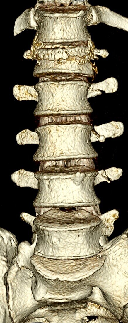 Lumbar spine, CT scan