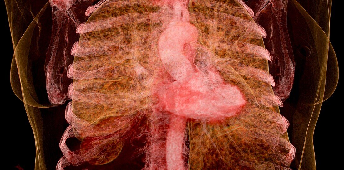 Thorax, CT scan