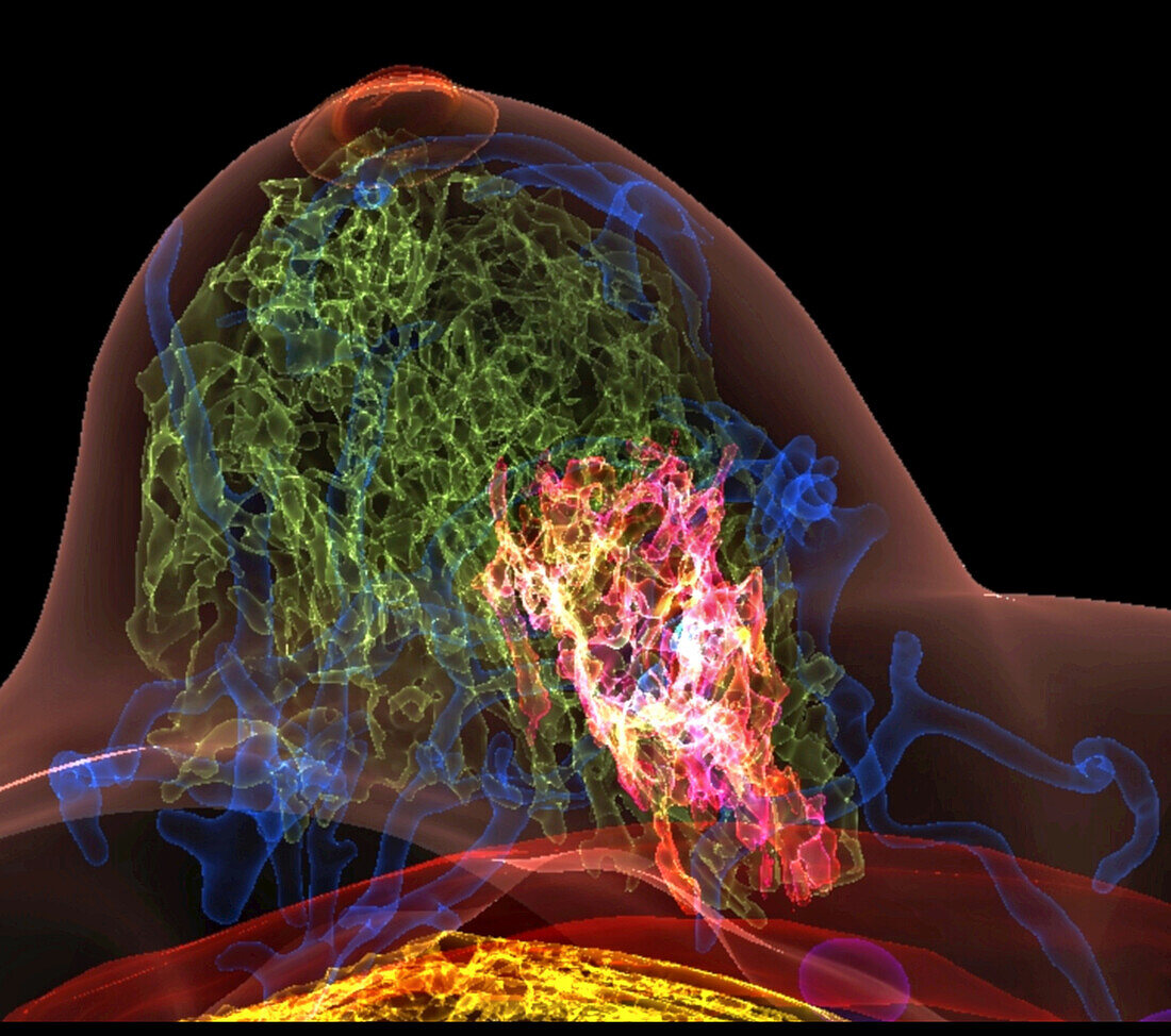 Breast cancer, combined MRI and CT scans